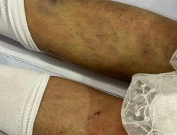 Dugaan Kematian Evi Maria Mangolo: Analisis Indikasi Kekerasan Fisik dan Penolakan Narasi Bunuh Diri